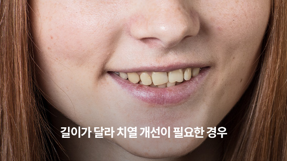 길이가 달라 치열 개선이 필요한 경우