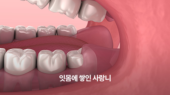 잇몸에 쌓인 사랑니