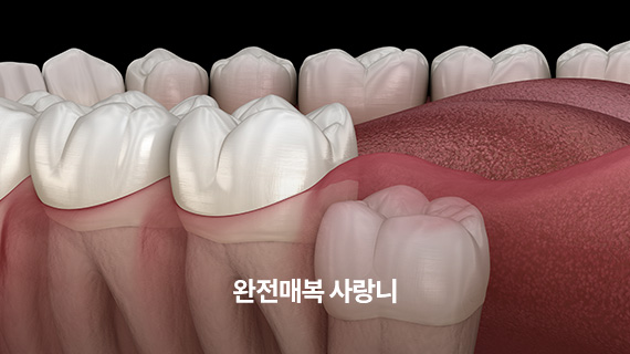 완전매복 사랑니