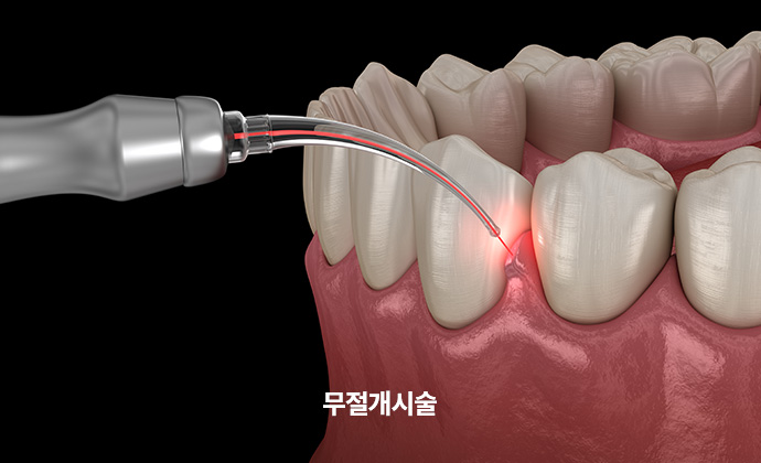 무절개시술